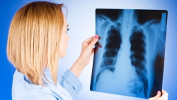 Альметьевцы могут обратиться на «горячую линию» по профилактике туберкулеза